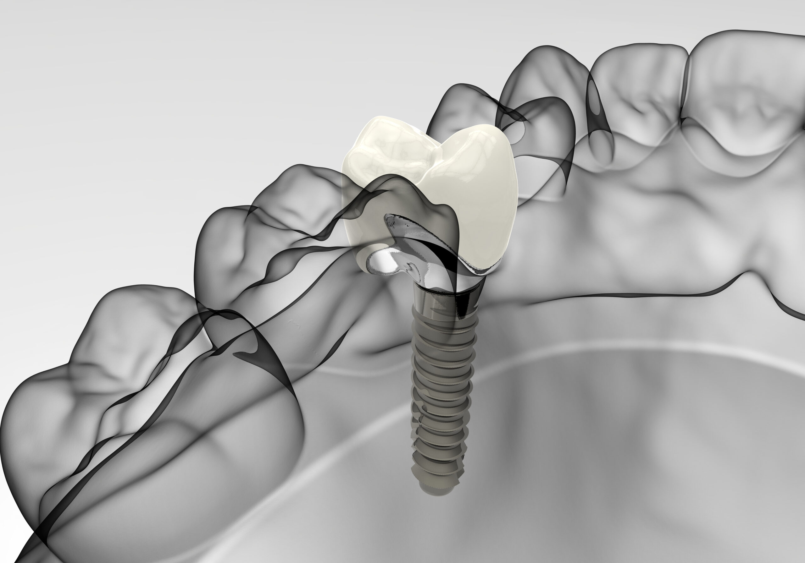 ¿Por qué apostar por los implantes dentales?