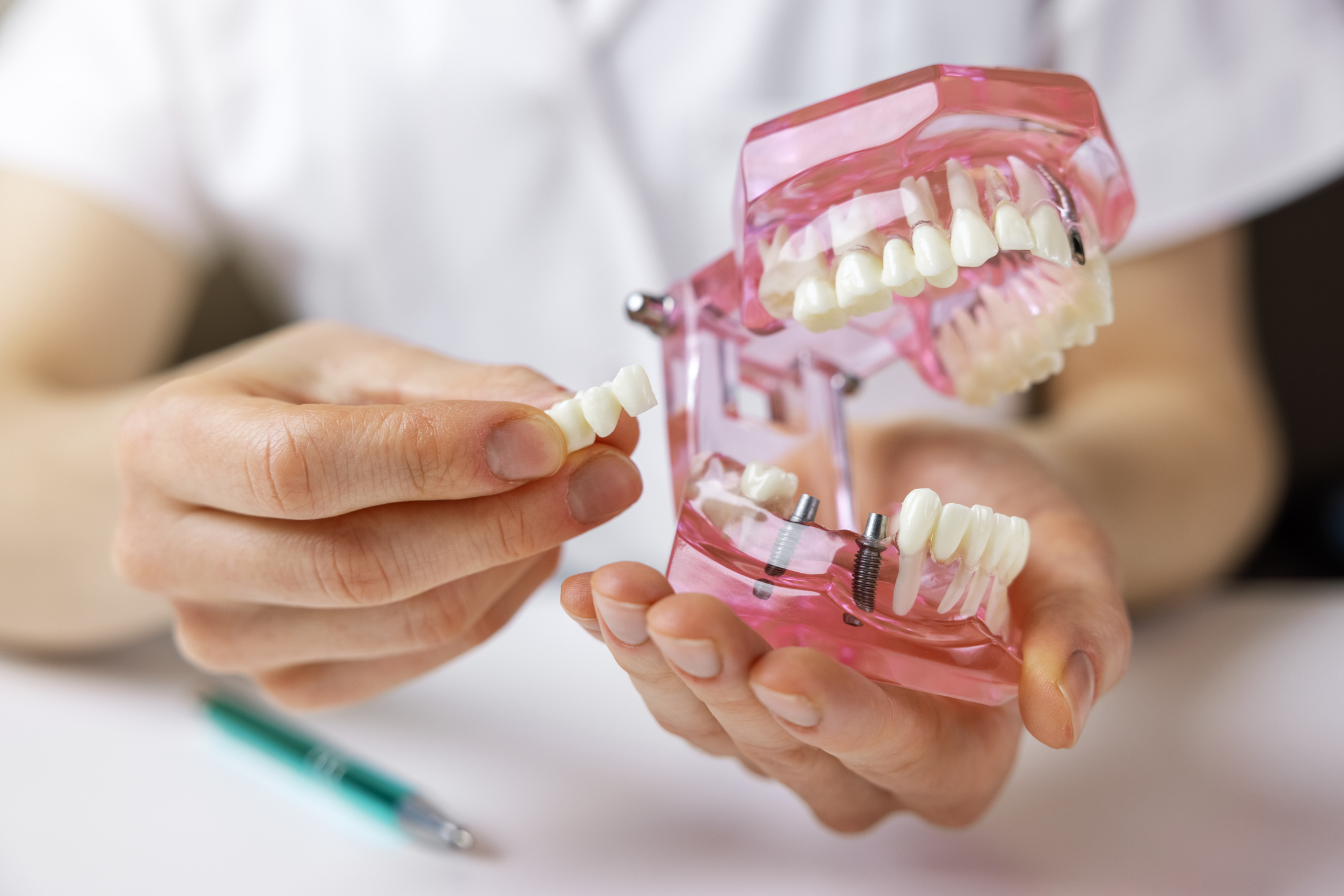 Implantes dentales: ¿son una opción para todos?